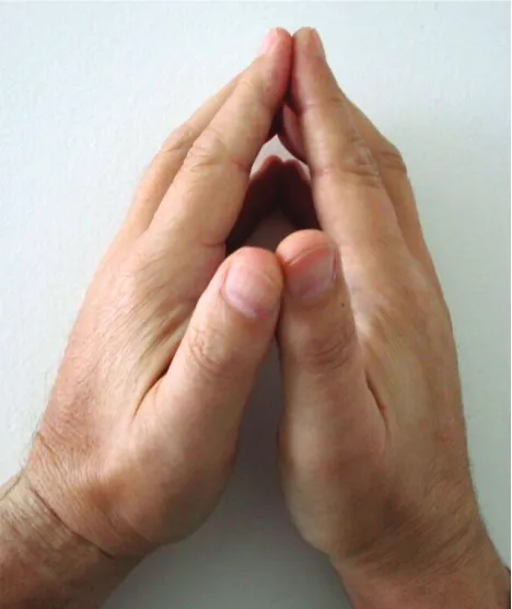 Figure 3 – Prayer sign: Hand stiffness resulting from flexion con-tractures of the fingers and thickened, tight, waxy skin
