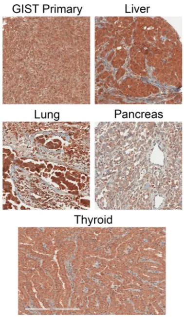 Figure 1: Example IHC images of cancer specimens using the CCK2R specific antibody 6C10G11