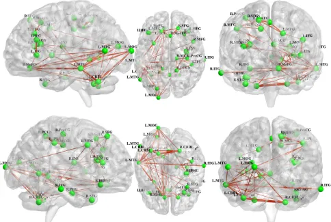 Figure 2 : All 31 regions extracted from the genotype-by-aMCI interactions for the cholesterol pathway, after correcting for imaging space for any one SNP [Pcorrected(S) < 0.05], were used to delineate a unidirectional weighted network with 31 nodes and 46
