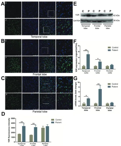 Figure 2: The expression and distribution of Y2R in different cortical lobes of FCD patients