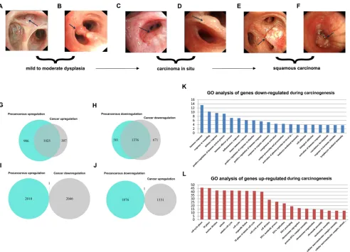 Figure 2: Identification of consistent DEGs and GO enrichment analysis. A.-F. Bronchoscopic manifestation of multi-stage tissues during LSQC carcinogenesis
