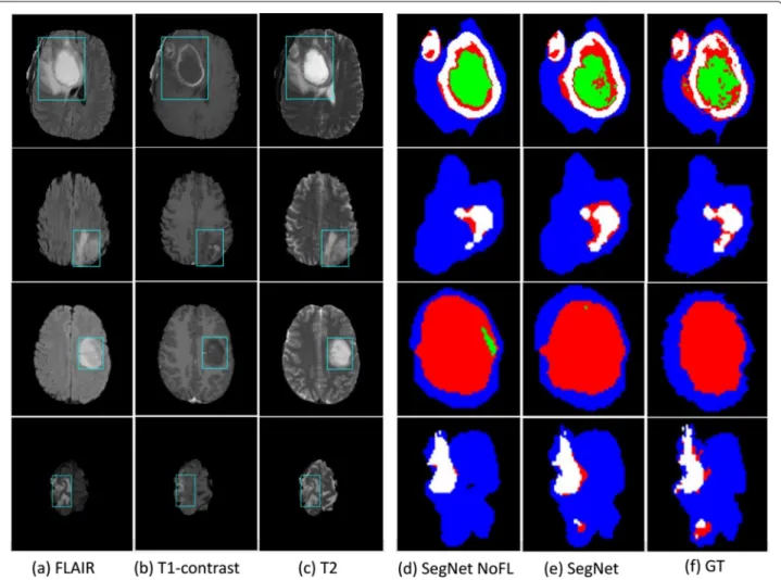 Fig. 4 Segmentation results on several examples. a FLAIR, b T1-contrast, c T2, d results of Brain SegNet without Focal loss, e results of Brain SegNet with Focal loss, and f ground truth