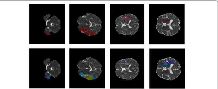 Fig. 5 Segmentation results of ischemic stroke lesion on a number of MRI slides (3D MRI diffusion map (ADC))