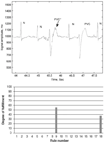 Figure 1: ECG signal showing two PVCs detected and corresponding degree of fulfilment versus  ANFIS decision rule [7] 