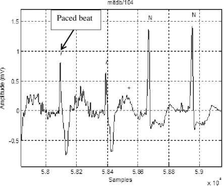 Figure 12: Example of a paced beat from MIT-BIH database, record 104, lead:  