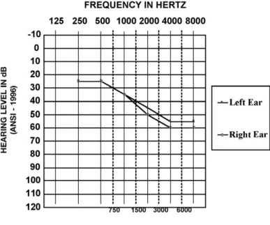 Figure 3. Average audiogram for participants with bilateral hearing impairment.