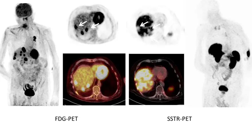 Figure 1: Example of SSTR-negative SCLC (patient #1). Maximum intensity projections as well as transaxial slices of FDG- and SSTR-PET/CT are displayed