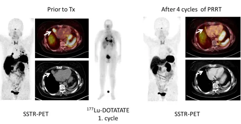 Figure 2: Example of SSTR-directed PET imaging matching immunohistochemical quantification of receptor expression