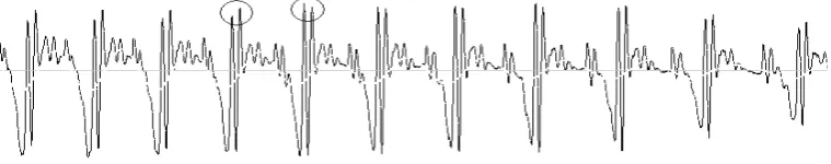 Figure 4 An example of a waveform (syllable /a/ of tone 3), in which the largest peak does not correspond to the largest one in the next period (indicated by the circles)