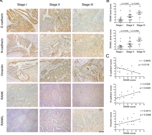 Figure 1: Expression of RANK/RANKL and EMT markers in human EC tissue specimens. (A) IHC analysis of RANK, RANKL, E-cadherin, N-cadherin and Vimentin in EC (stage I, II, III)