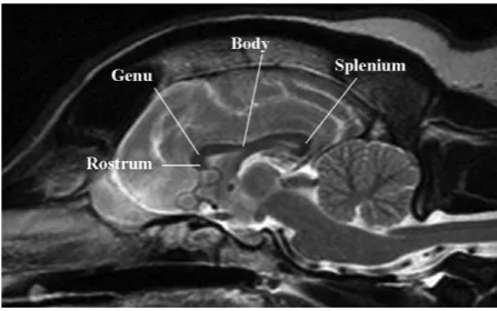 Fig 1.Midsagittal T2-weighted MR image of a normal corpuscallosum.