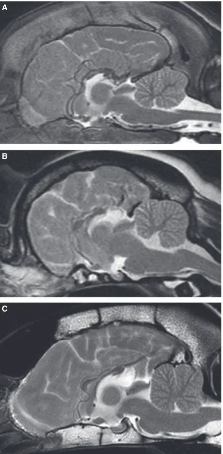 Fig. 2.Midsagittal T2-weighted MR images of (and dysplastic CC, and (Rottweiler with absence of the rostral CC and hypoplasia of thecaudal portion, (A) 3-monthB) 18-month Pug with a diﬀusely hypoplasticC) 3-year 6-month Border Collie with adiﬀusely hypoplastic CC.