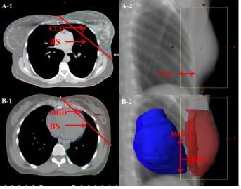 Figure 7: Electronic tissue compensation was employed to create a dynamic MLC fluence map