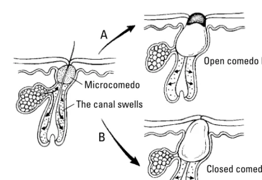 Figure 3-4: The microcomedo forms and becomes either a blackhead (A) or awhitehead (B).