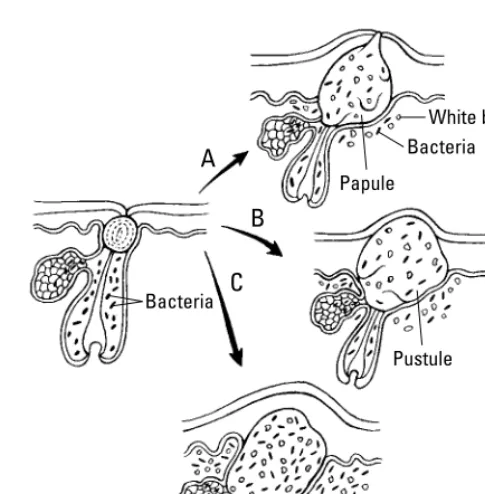 Figure 3-5: The microcomedo becomes an inflammatory papule (A), pustule (B), or nodule (C).