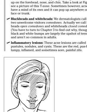 Figure 4-1: Teens often experience acne flare ups in the T-zone.