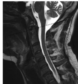 FIG 1. Sagittal T2 image from a healthy control demonstrating thecoverage of the axial diffusion kurtosis sequence, centered on theC2–3 intervertebral space.