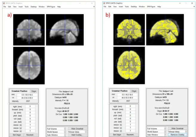 Figure 2.5: An example of an fMRI visualisation using SPM [72] showing the results of  white matter (WM), grey matter (GM) and cerebrospinal fluid (CSF) after segmentation  with FSL FAST [64]: (a) the original fMRI image with a voxel size of 2x2x2mm; (b) t