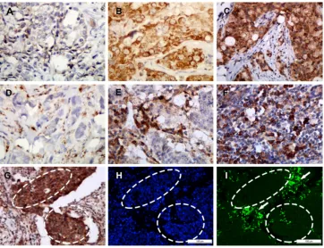 Figure 1: Representative SAA staining intensities by immunohistochemistry. Staining was localized to the cytoplasm or to the membrane of tumor cells (A–C): a, Intensity 1+, no or weak staining; b, Intensity 2+, moderate staining; c, Intensity 3+, strong st