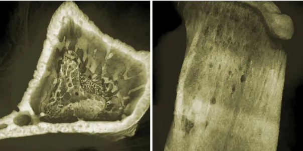 Figure 1.2: Real-time rendering of bone lesions caused by myeloma. [159]