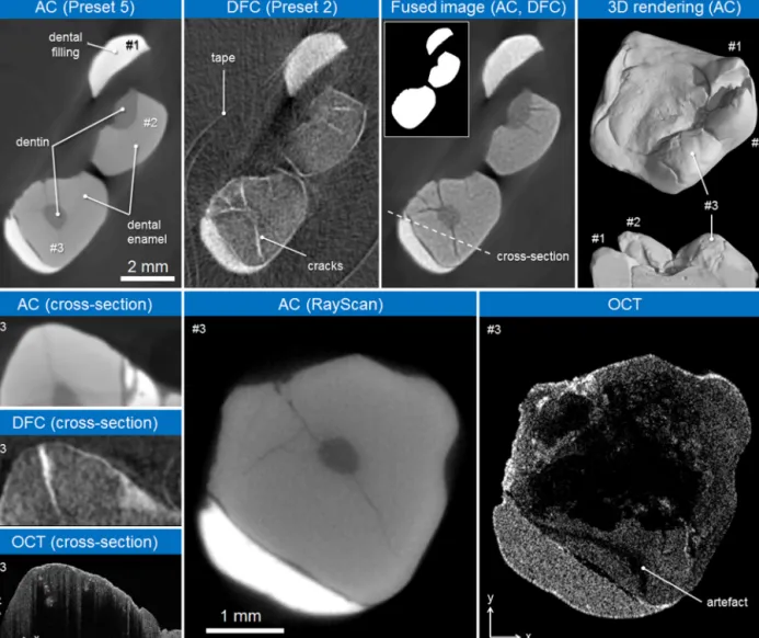 Fig. 4. μXCT slice images concerning AC (preset 5), DFC (preset 2), a fused image, AC (RayScan) and its 3D rendering as well as OCT results showing a large crack in the dental enamel phase of the occlusal surface of a molar tooth (three lower left images).