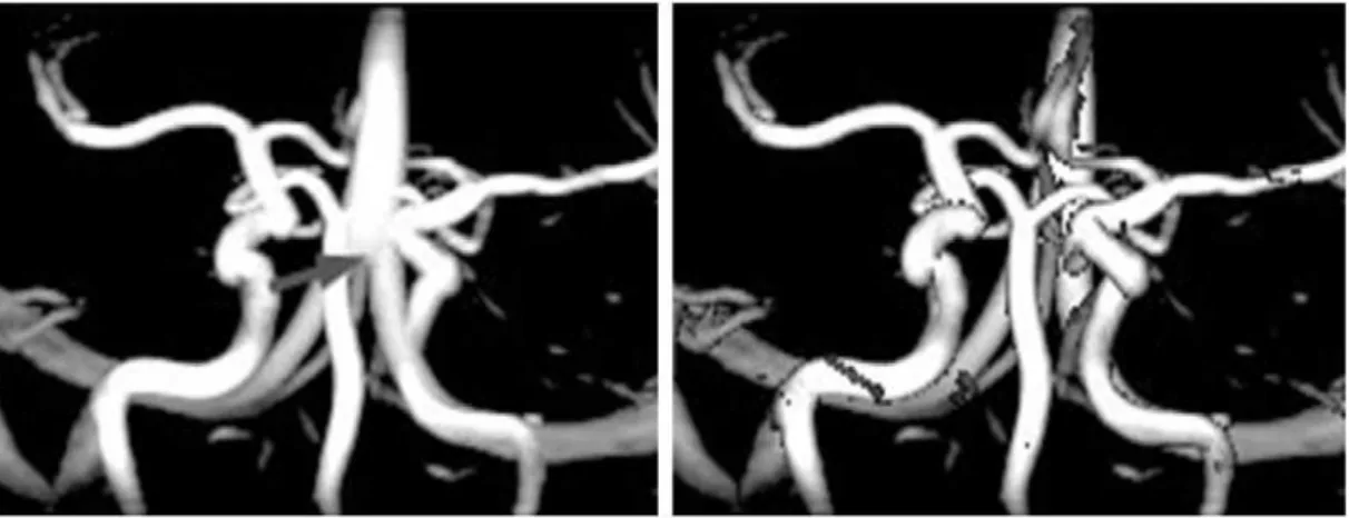 Figure 2.17   Illustrations of MIP-based and LMIP-based imaging methods (courtesy to Sato et al.) 