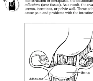 Figure 3-3:Adhesions