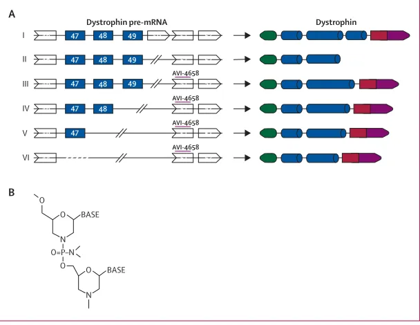Figure 1: Deletions and predicted results of exon skipping in the patients who were studied(A) Pre-mRNA transcripts and dystrophin protein products from full length DMD, in patients with Duchenne muscular dystrophy, and predicted protein sequences after ex