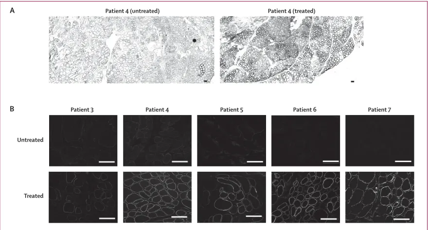 Figure 3: Dystrophin expression in patients treated with high-dose AVI-4658Transverse sections of treated and contralateral EDB muscles that were immunostained for dystrophin with MANDYS106