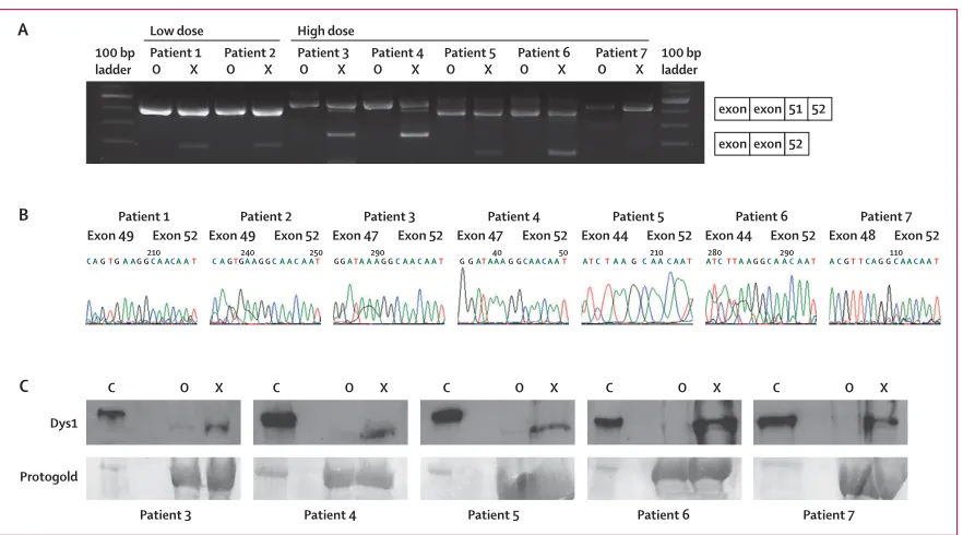 Figure 5: Exon 51 skipping in ampliﬁ ed RNA from treated muscles(A) RT-PCR analysis of RNA extracted from treated (X), untreated (O), and control (C) muscle sections detects shorter transcript fragments in the treated muscles, with sizes that correspond to