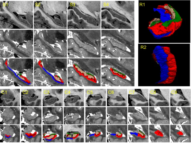 Fig. 7. Sample images (T1 and T2 weighted) and manual segmentations of “subject 1” from (Winterburn et al., 2013)