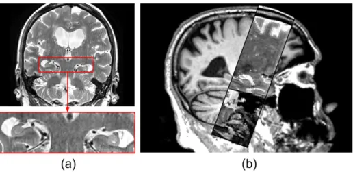 Fig. 12. Inputs (T1, T2) and segmentations for ﬁve representative cases of the ADNI T1/T2 dataset