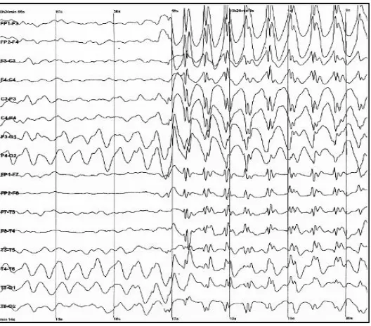 Figure 2.4 Epileptic Spike and Wave Discharges Monitored with EEG [5]