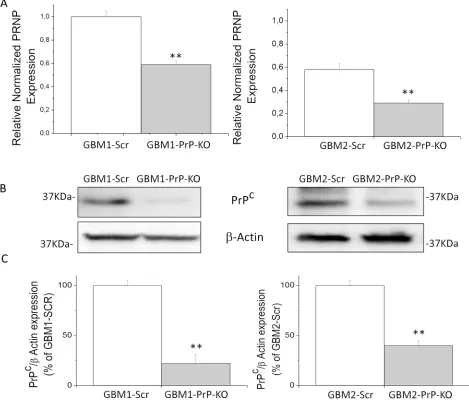 Figure 2: A. Prion protein mRNA expression in GBM1 (left) and GBM2 (right), evaluated by quantitative RT-PCR