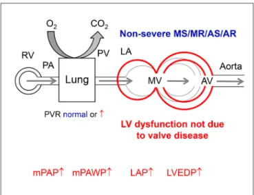 figuRe 3  |   Hemodynamics of group 2 pulmonary hypertension due to  non-valve disease related left ventricular (LV) dysfunction in a patient with  non-severe mitral stenosis (MS), mitral regurgitation (MR), aortic stenosis (AS),  or aortic regurgitation (