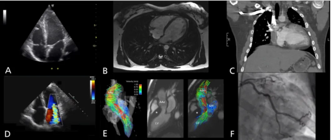 Figure 3.10: Examples of structural and functional cardiovascular imaging, provided by ultrasound  ((A) B-mode and (D) Colour Doppler), MRI ((B) T1-weighted and (E) 4D flow) and CT ((C) spiral  CT and (F) Coronary angiography)