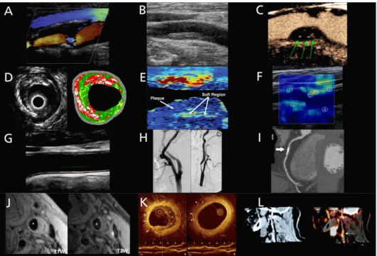 Figure  3.17:  Overview of a few image techniques for plaque characterisation or plaque risk  assessment
