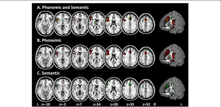 Figure 2 Shows the significant cluster of brain activation in the processing of verbal fluency, threshold: p <0.05 using a False Discovery Rate (FDR) correction and a minimum clusters size of 100 mm3