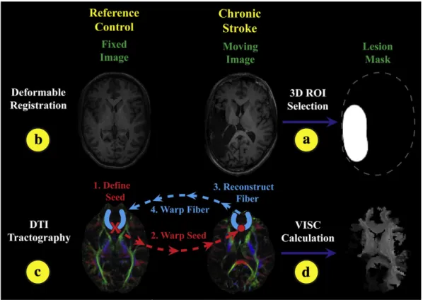 Fig. 2. In registering a stroke brain (a) to the template control (b), the original deformation algorithm (c) was modiﬁed to include lesion masking (d) and anisotropic smoothing (e) to produce the best result.