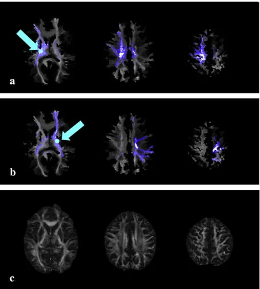 Fig. 5. Bilateral voxels were selected from the posterior limb of the internal capsule (PLIC) in a chronic stroke subject with a lesion localized to the right anterior limb of the internal capsule (ALIC)