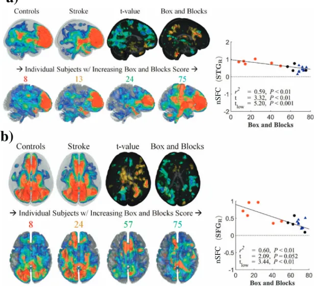 Fig. 8. Behavioral correlations of nSFC in prefrontal and default-mode networks. SFC-enhanced prefrontal network (a) and default-mode network (b) are shown in stroke subjects, age- age-matched controls, and individual stroke subjects