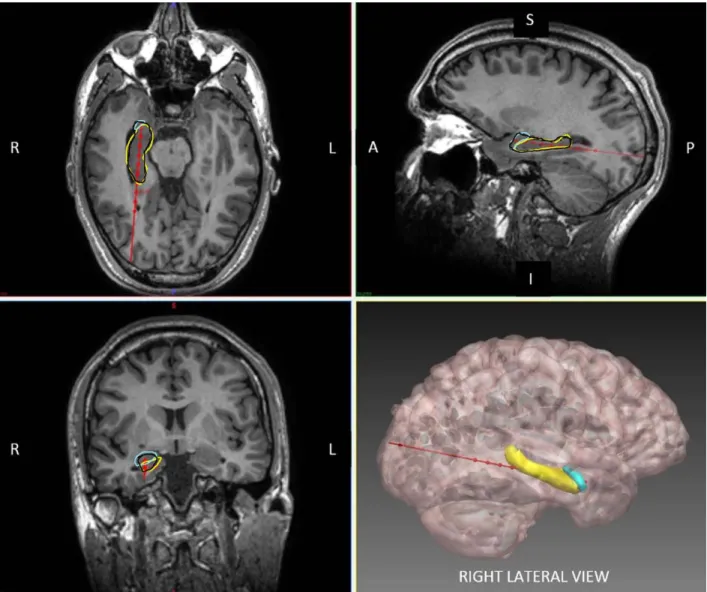 FIGURE 3: Axial, sagittal, coronal, and 3-dimensional reconstruction of planned laser ablation trajectory (red) with outline of hippocampus (yellow), amygdala (cyan), and modeled ablation cavity (black)