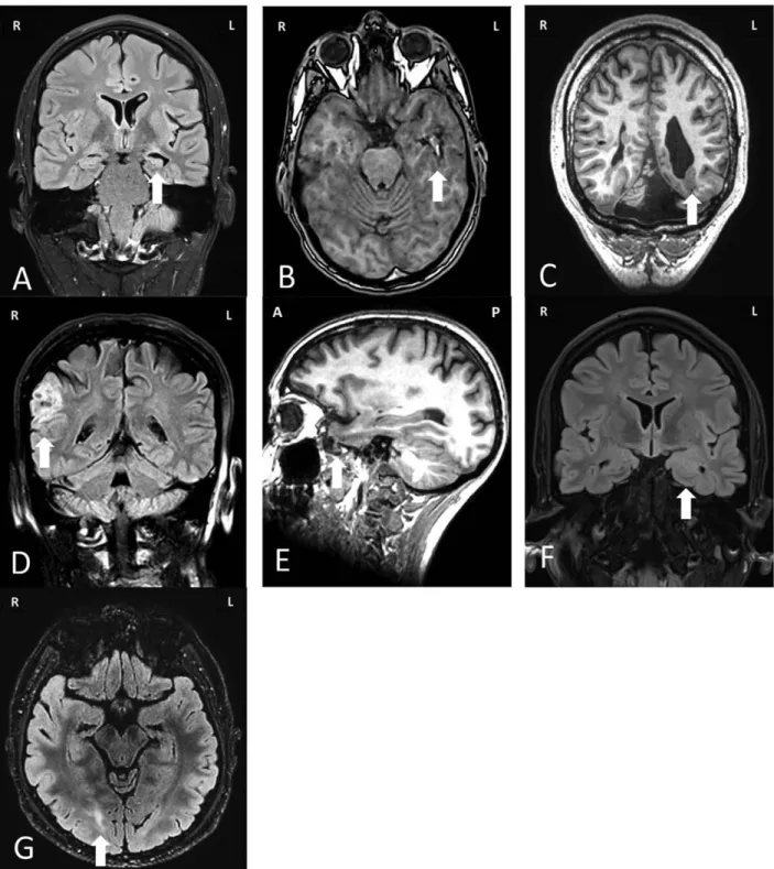 FIGURE 1: Magnetic resonance imaging of common pathologies underlying drug-resistant focal epilepsy that are amenable to surgi- surgi-cal treatment
