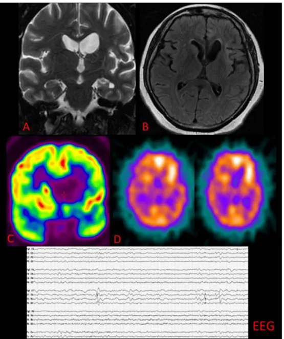 Fig. 4 Non-concordance among the MRI, PET and ictal SPECT in a female patient, 48 years old with intractable left complex partial seizures