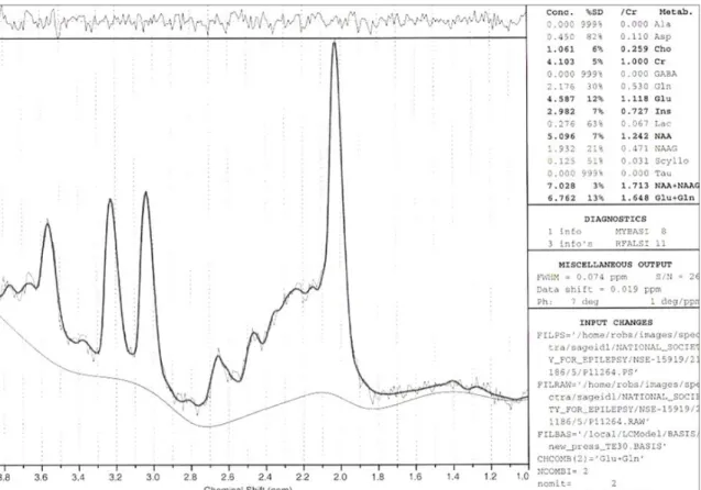Figure 2.2.2  Typical LCModel output acquired in a patient with IGE examined in the right  frontal lobe with TE/TR = 30ms/3000ms and showing LCModel estimates for the obtained  metabolite  concentrations  in  the  upper  right  hand  section  of  the  outp