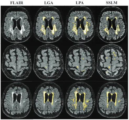 Fig. 1. Example WMH segmentation results compared with LGA and LPA on three different subjects with Fazekas score 1, 2 and 3 (from bottom to top) respectively.