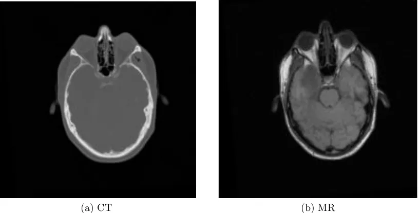 Figure 3.1: Axial slices of CT and MR images from patient ﬁve.