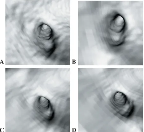 Figure 3. VE images were acquired with variable sectionthickness of 1.0 mm, 1.5 mm, 2.0 mm and 3.0 mm, pitch1.0 with reconstruction interval of 50% section thickness(A-D)