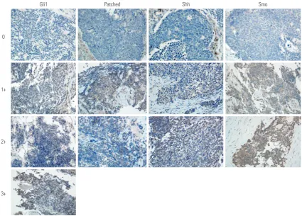 Fig. 1. Representative immune-histochemical staining intensity for Gli1, patched, sonic hedgehog (Shh), and Ptch-mediated repression of smoothened (Smo) in patients with extensive stage small cell lung cancer