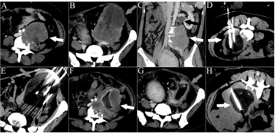 Figure 4: CT images of a 33-year-old man who underwent 3 sessions of cryoablation for 2 RPSs